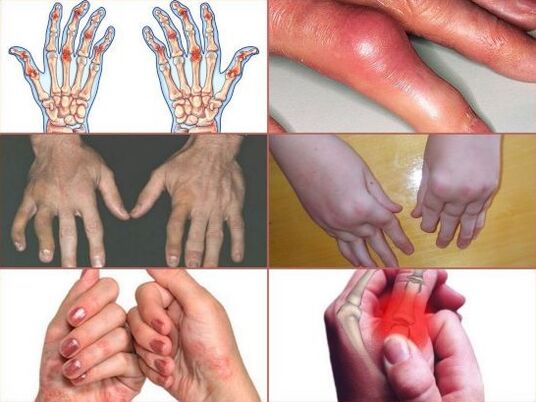 ból stawów palców