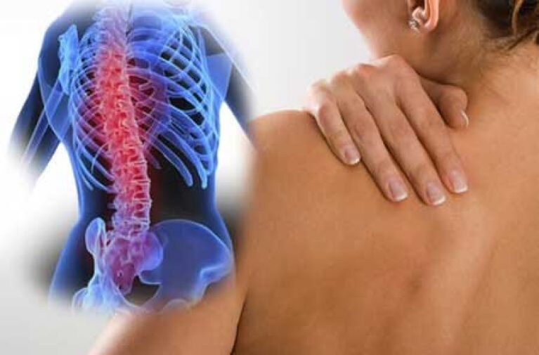 Podczas zaostrzenia osteochondrozy kręgosłupa piersiowego pojawia się ból dorsago