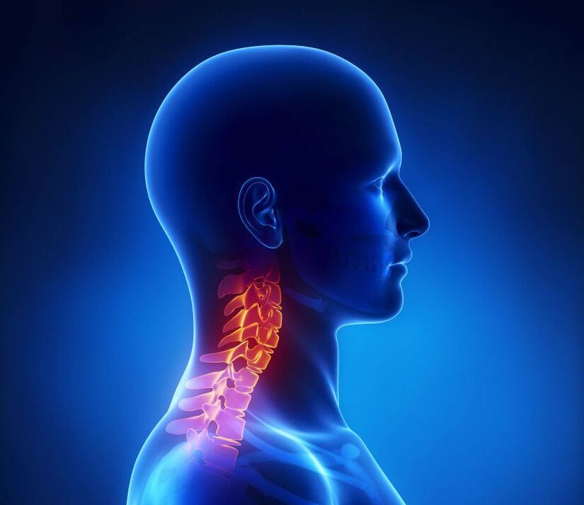 Osteochondroza szyjna to patologia kręgosłupa, której można się pozbyć w domu