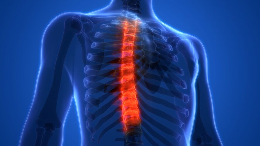 Osteochondroza kręgosłupa piersiowego charakteryzująca się zniszczeniem krążków międzykręgowych