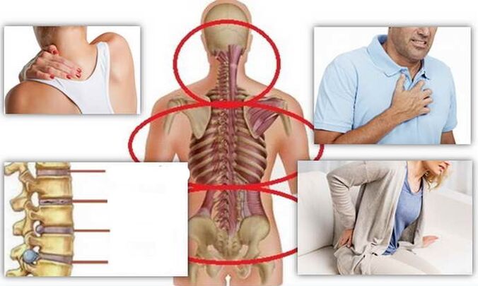 Miejsca choroby na osteochondrozę