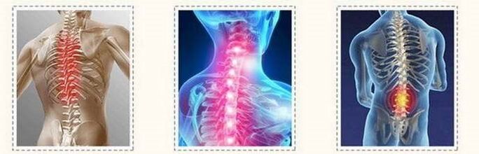 Uszkodzenia kręgosłupa osteochondrozy