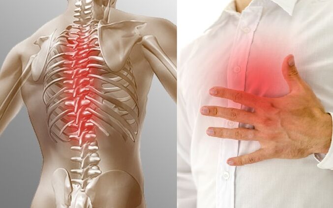 Osteochondroza klatki piersiowej objawia się bólem i uczuciem ucisku w klatce piersiowej